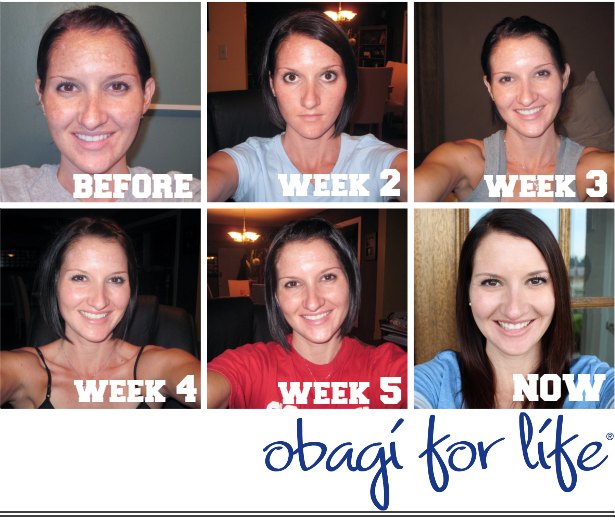 Obagi Skin Care System - The First Few Weeks